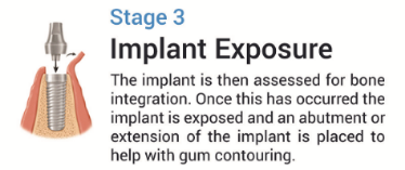 Implant stage 3-266-615-81